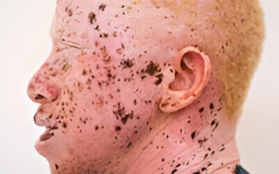 The Silent Threat of Skin Cancer in Albinism.