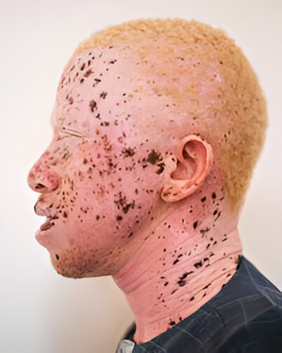 The Silent Threat of Skin Cancer in Albinism.